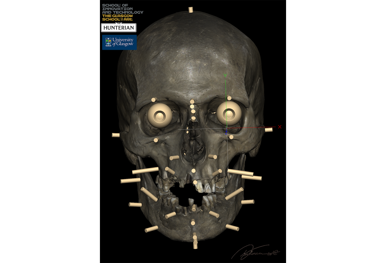 Facial Soft Tissue Depth Markers on the Clachaig Skull, which was scanned with the Artec Spider II Light Scanner.