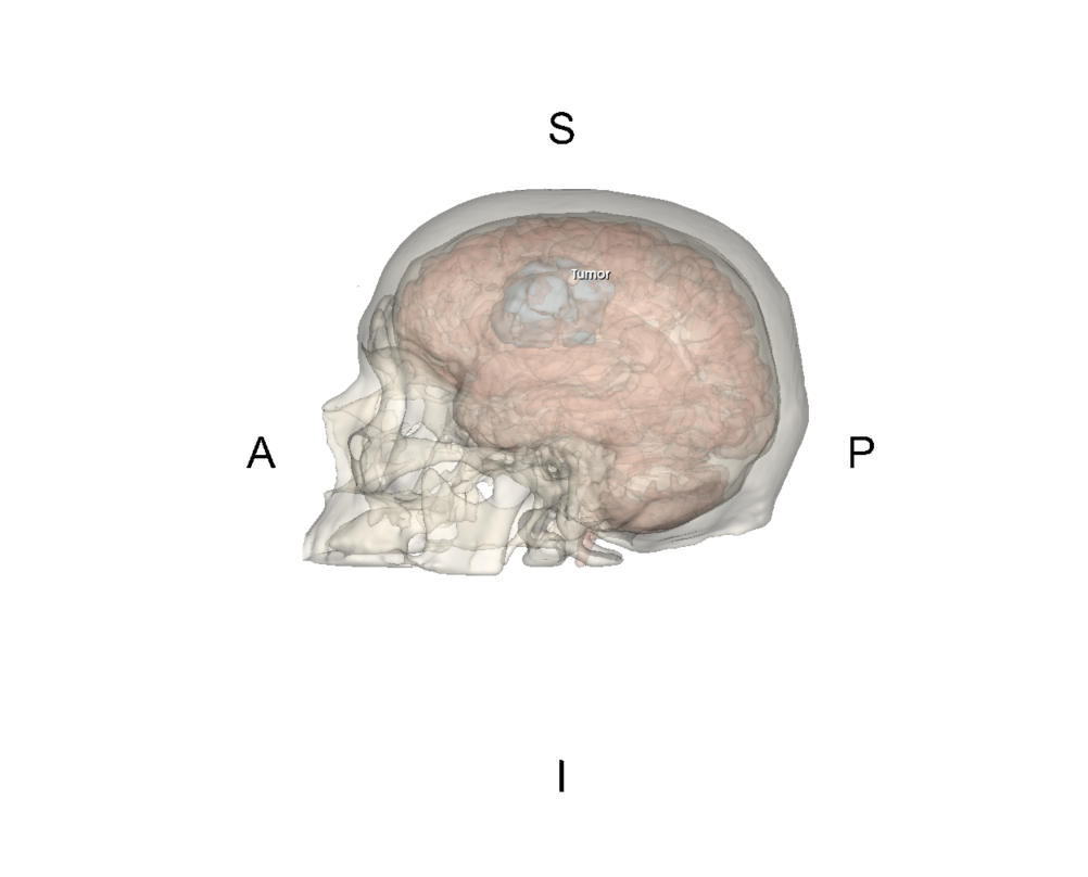 Volumetric Visualisation of a Tumor Using 3D Slicer on an open-source DICOM scan (MSc project).