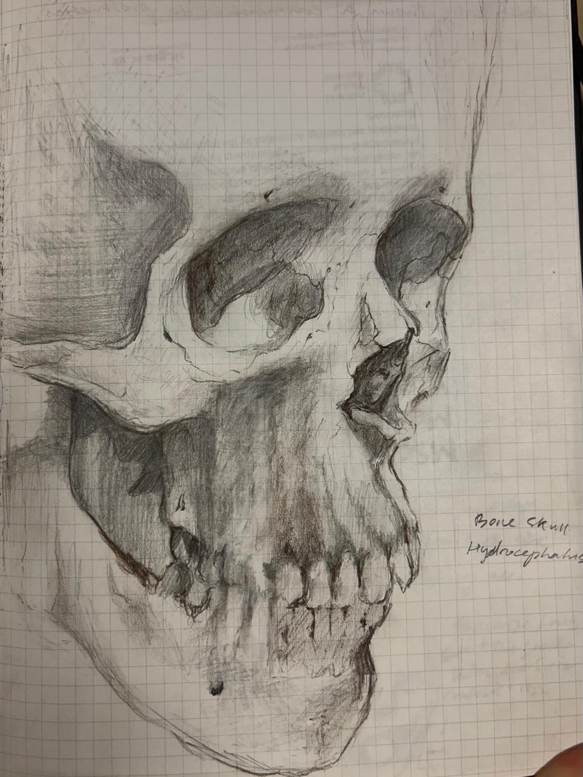 Observational drawing of a Hydrocephalic Skull from the Royal Surgeon's Museum collection, Edinburgh.